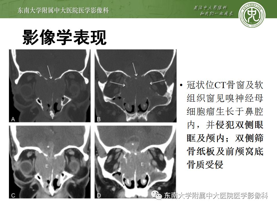 【病例】嗅神经母细胞瘤1例MR影像诊断