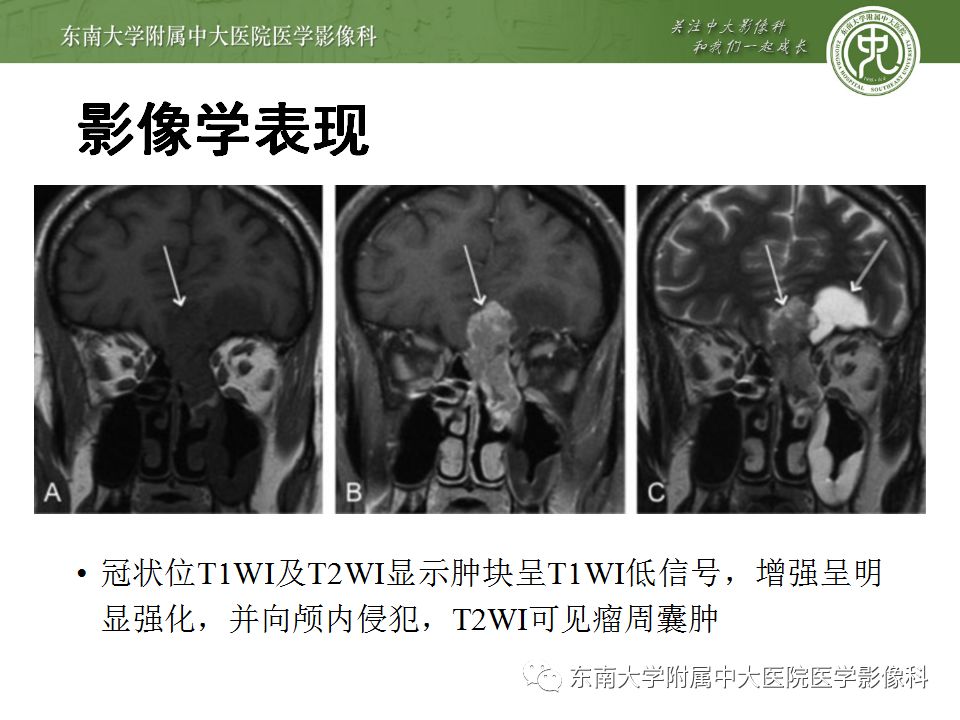 【病例】嗅神经母细胞瘤1例MR影像诊断