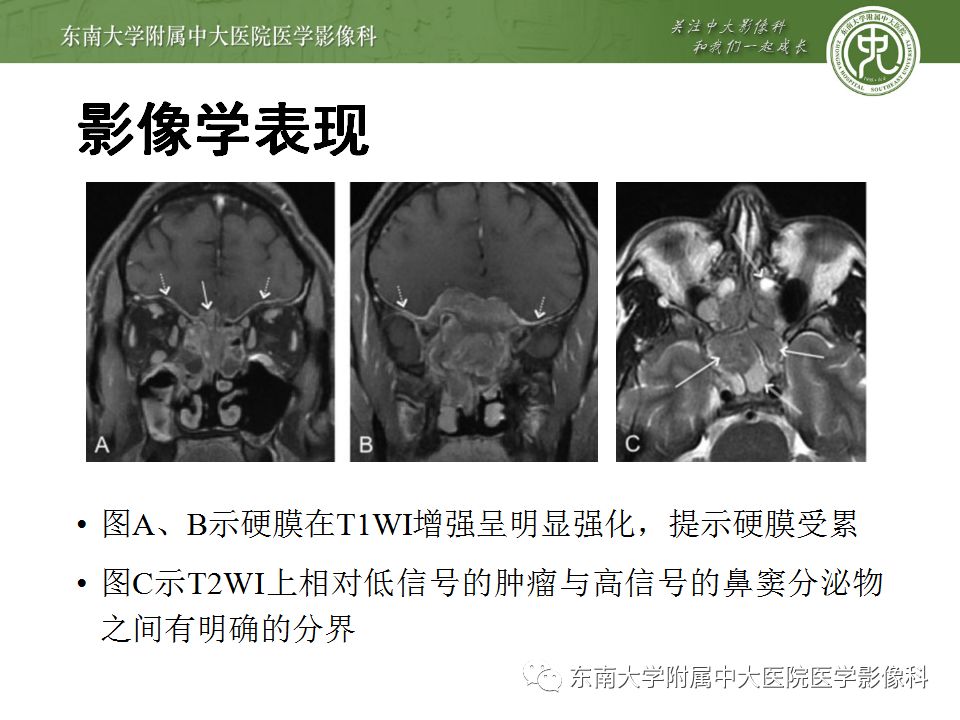 【病例】嗅神经母细胞瘤1例MR影像诊断