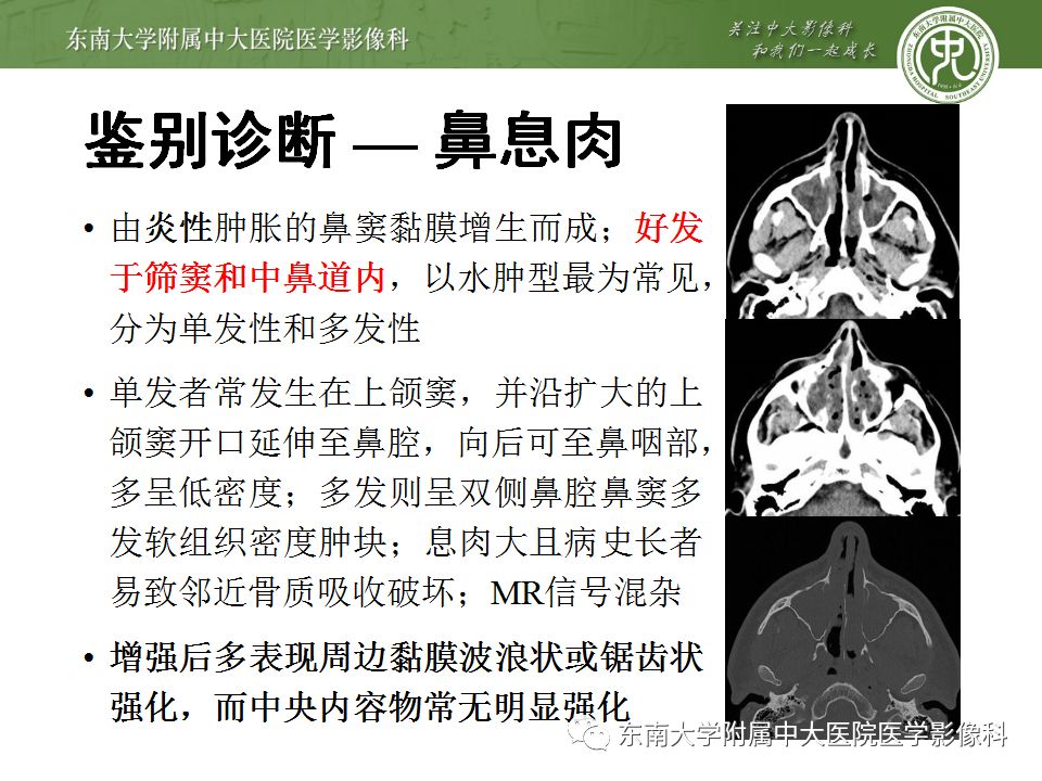 【病例】嗅神经母细胞瘤1例MR影像诊断
