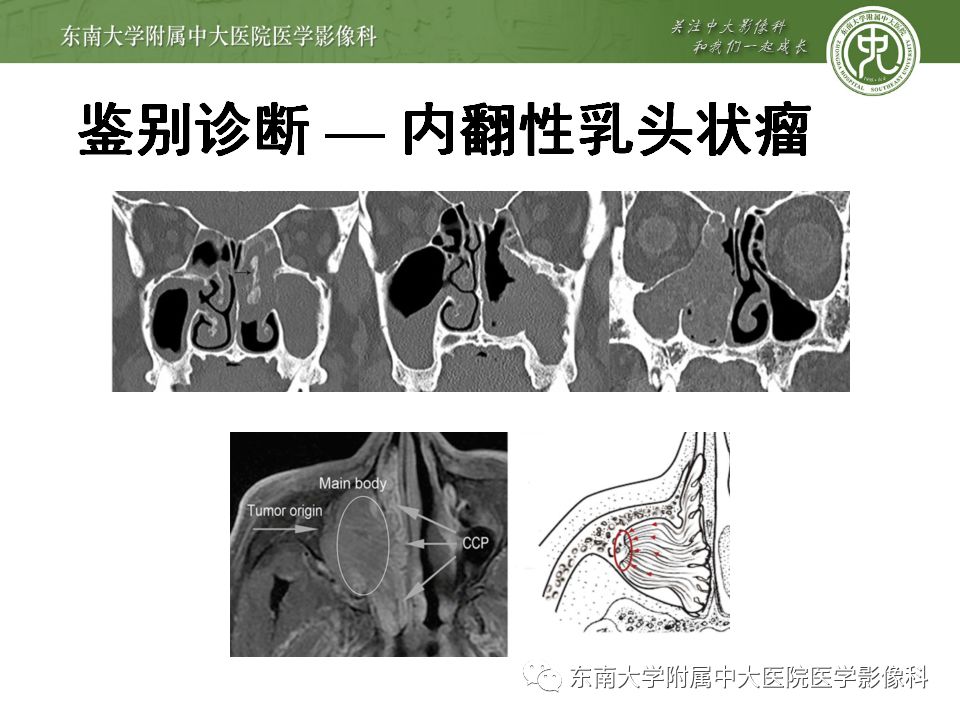 【病例】嗅神经母细胞瘤1例MR影像诊断