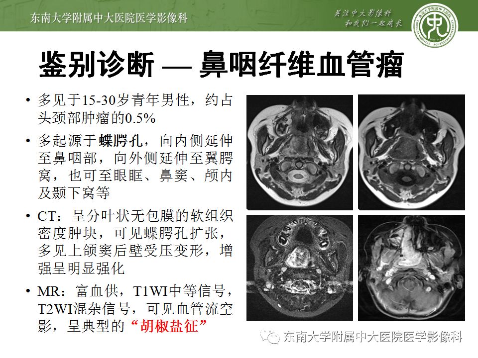 【病例】嗅神经母细胞瘤1例MR影像诊断