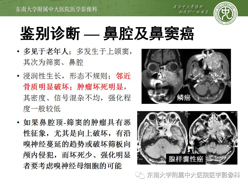 【病例】嗅神经母细胞瘤1例MR影像诊断