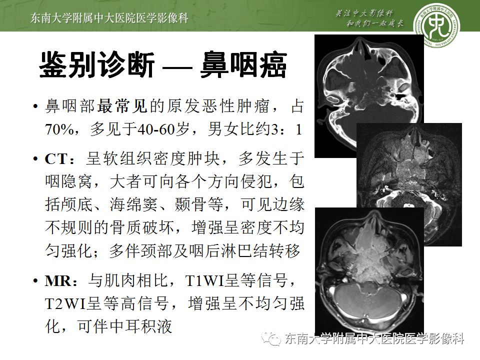 【病例】嗅神经母细胞瘤1例MR影像诊断