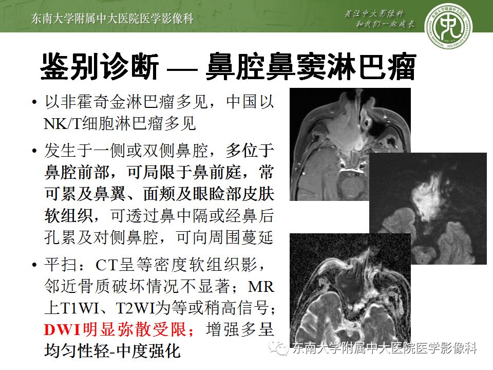 【病例】嗅神经母细胞瘤1例MR影像诊断