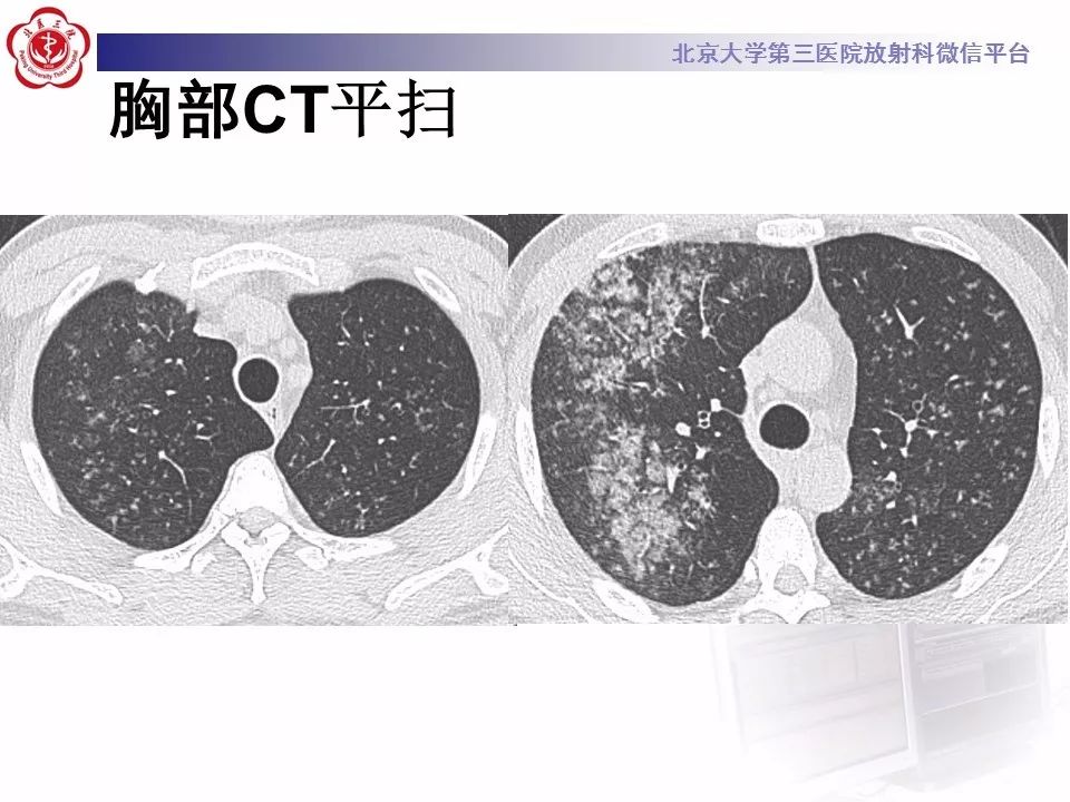 【病例】肺炎型肺癌1例CT影像表现