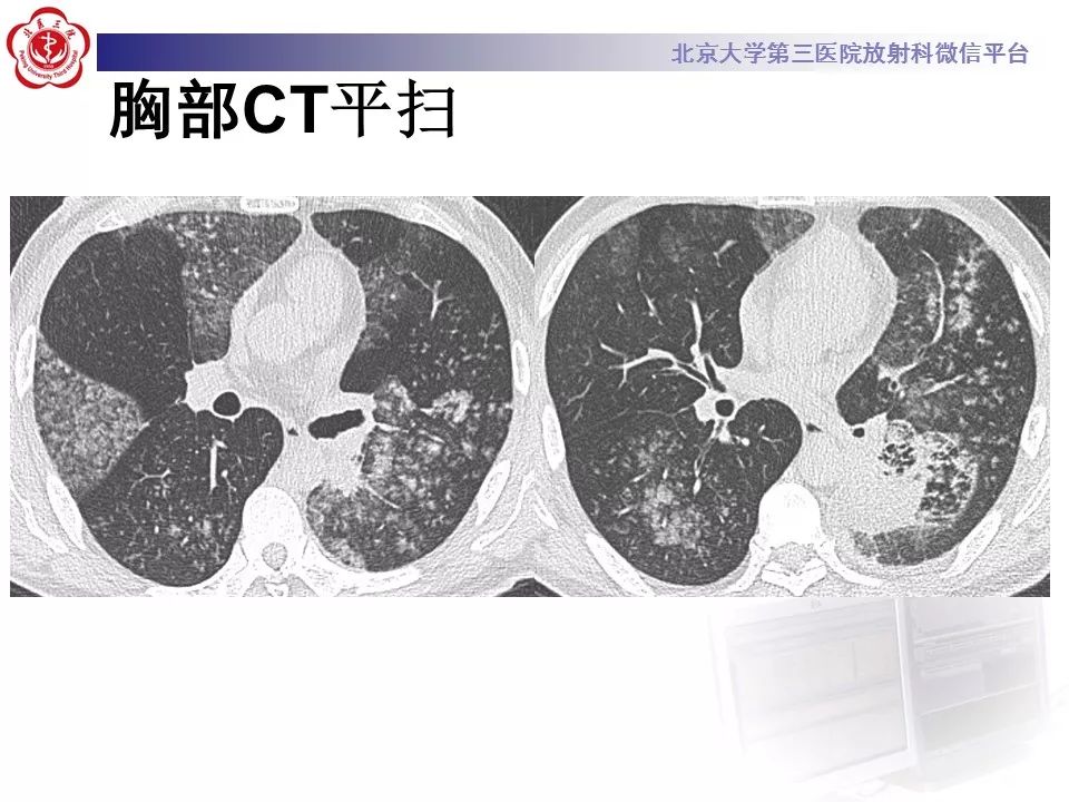【病例】肺炎型肺癌1例CT影像表现