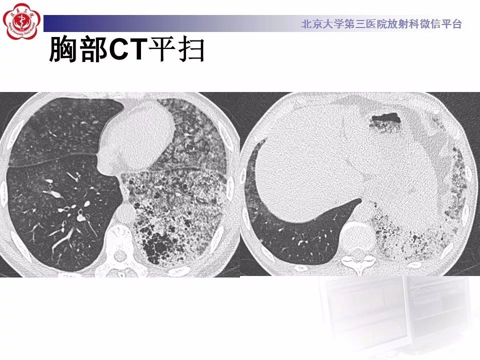【病例】肺炎型肺癌1例CT影像表现