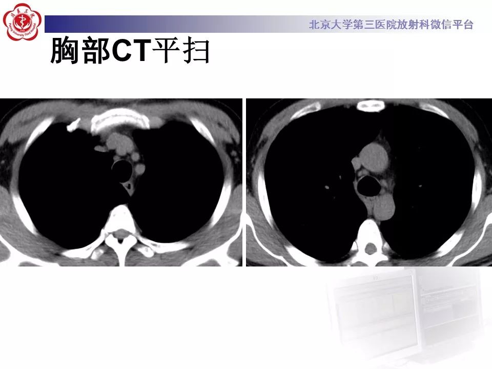 【病例】肺炎型肺癌1例CT影像表现