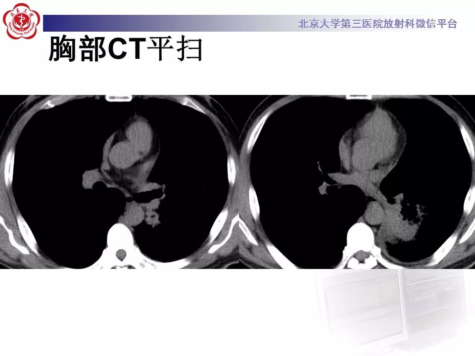 【病例】肺炎型肺癌1例CT影像表现
