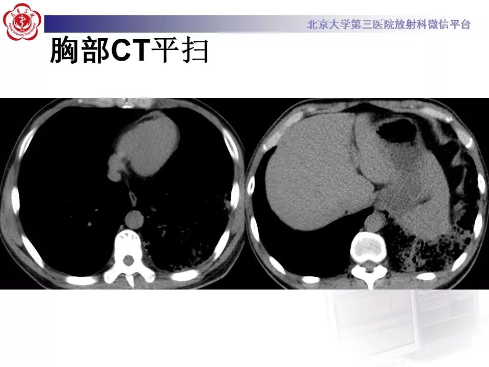 【病例】肺炎型肺癌1例CT影像表现