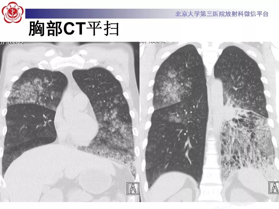 【病例】肺炎型肺癌1例CT影像表现