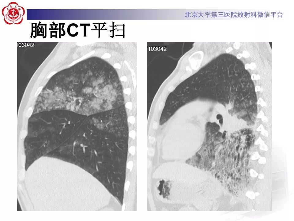 【病例】肺炎型肺癌1例CT影像表现