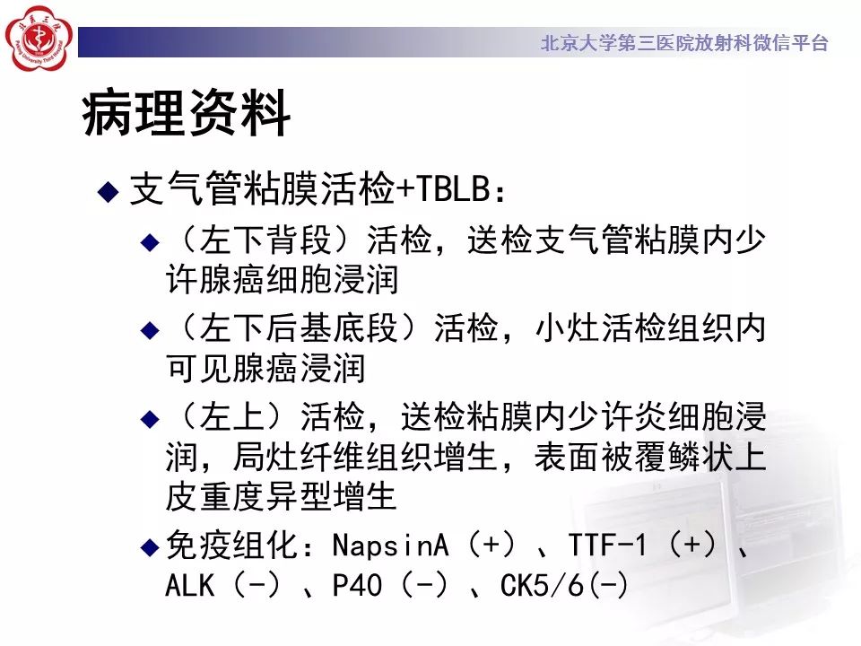 【病例】肺炎型肺癌1例CT影像表现