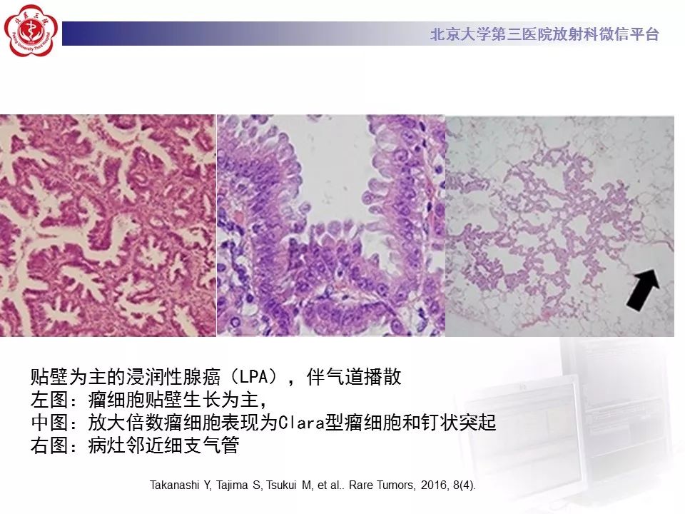 【病例】肺炎型肺癌1例CT影像表现