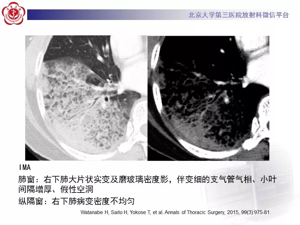 【病例】肺炎型肺癌1例CT影像表现
