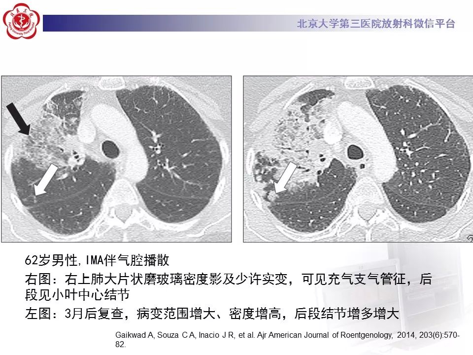 【病例】肺炎型肺癌1例CT影像表现