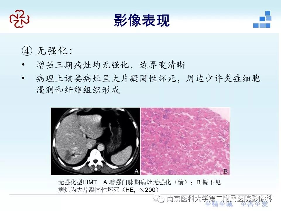 【PPT】肝脏炎性假瘤的影像表现