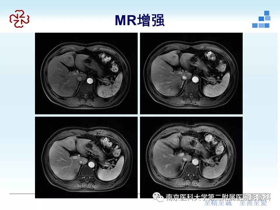 【PPT】肝脏炎性假瘤的影像表现