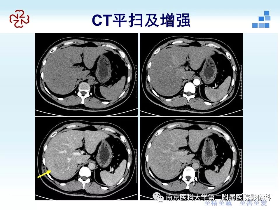 【PPT】肝脏炎性假瘤的影像表现