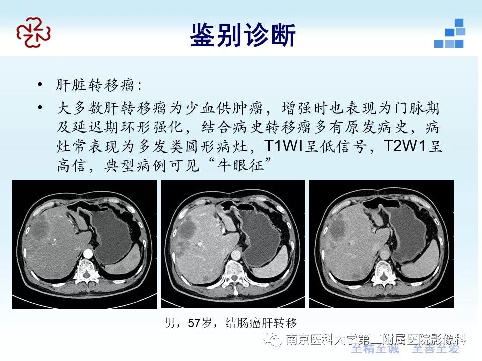 【PPT】肝脏炎性假瘤的影像表现