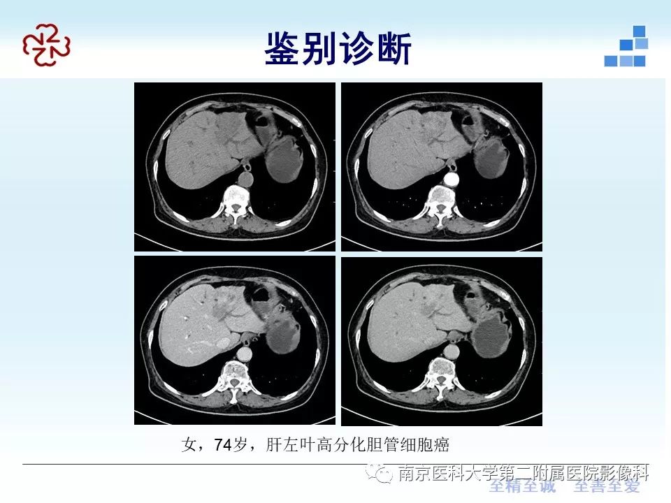 【PPT】肝脏炎性假瘤的影像表现