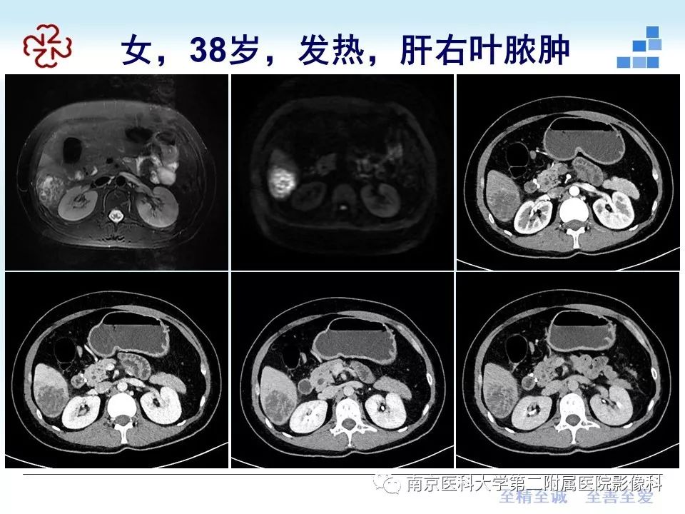 【PPT】肝脏炎性假瘤的影像表现