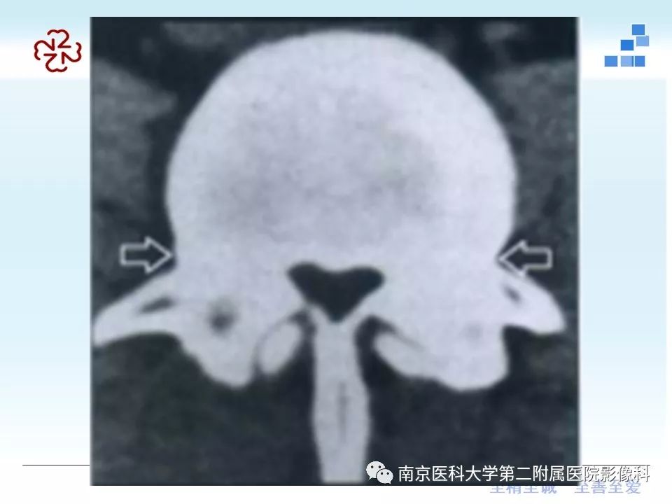 【PPT】椎管狭窄