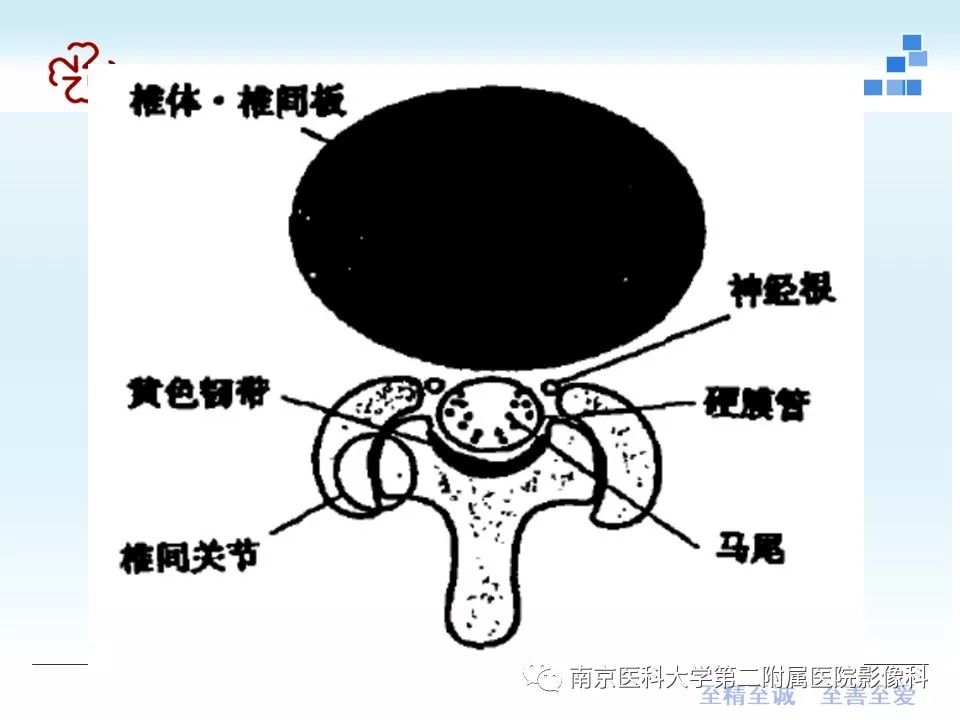 【PPT】椎管狭窄