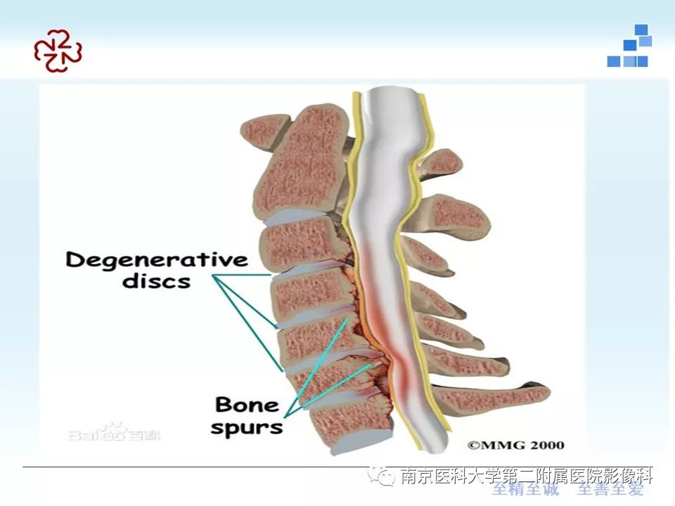 【PPT】椎管狭窄