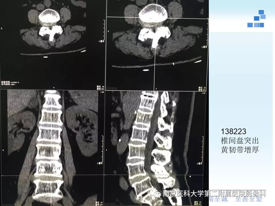 【PPT】椎管狭窄