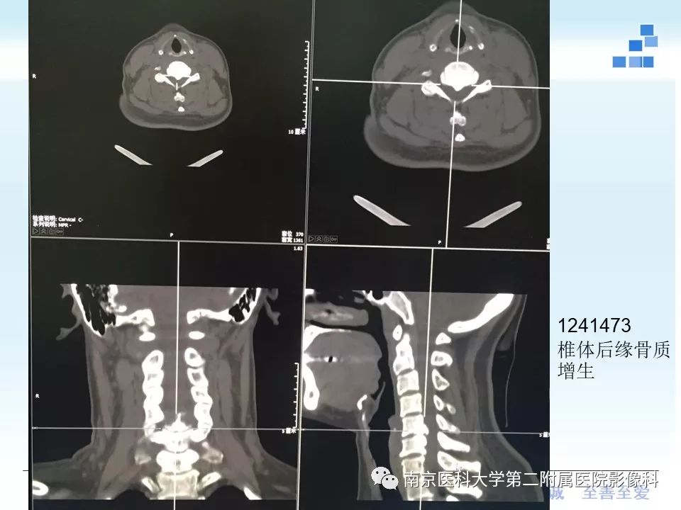 【PPT】椎管狭窄