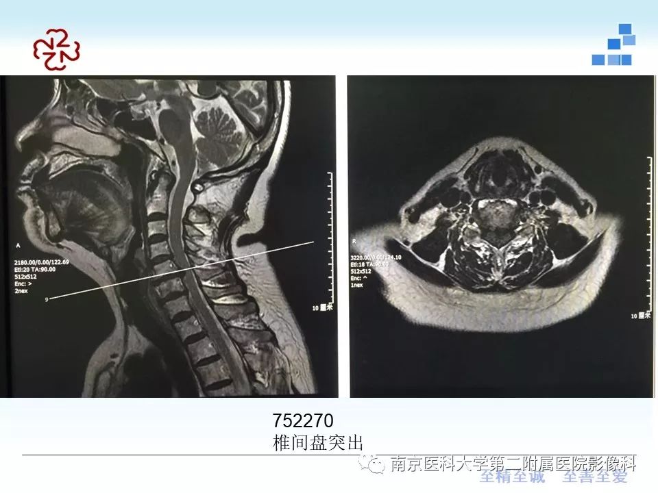 【PPT】椎管狭窄