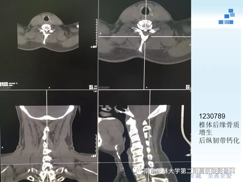 【PPT】椎管狭窄