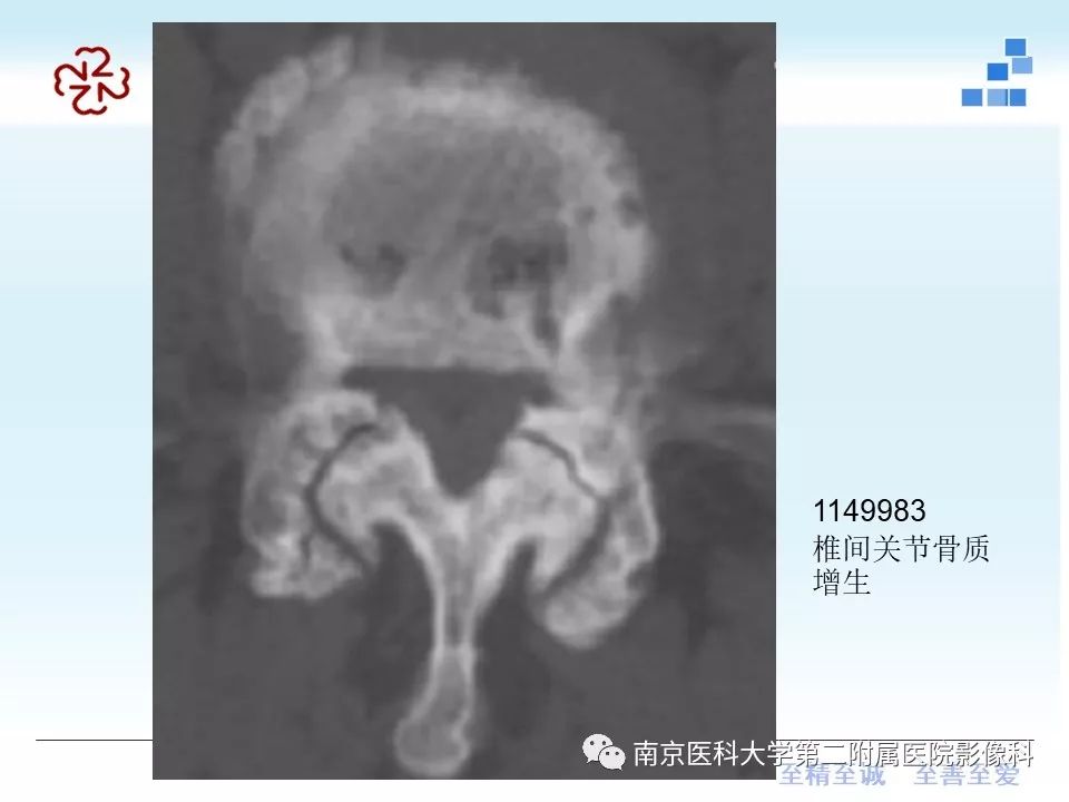 【PPT】椎管狭窄