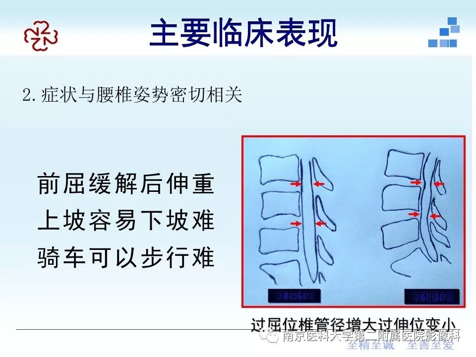 【PPT】椎管狭窄