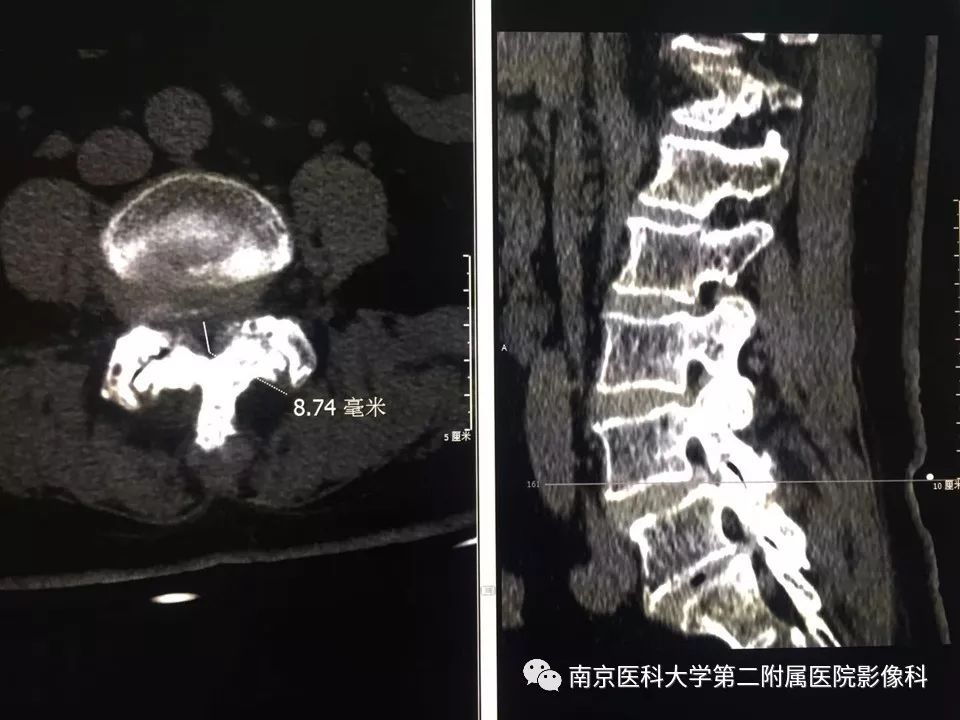 【PPT】椎管狭窄