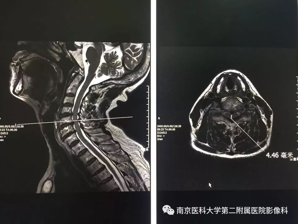 【PPT】椎管狭窄