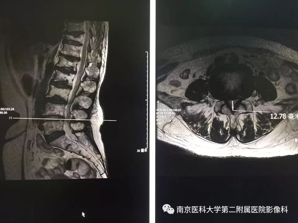 【PPT】椎管狭窄