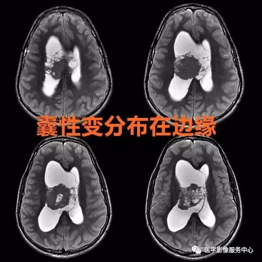 掌握4个特征,秒杀中枢神经细胞瘤 掌握4个特征,秒杀中枢神经细胞瘤