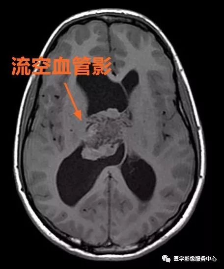掌握4个特征,秒杀中枢神经细胞瘤 掌握4个特征,秒杀中枢神经细胞瘤
