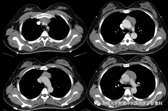 【病例】胸腺瘤1例CT影像诊断 【病例】胸腺瘤1例CT影像诊断