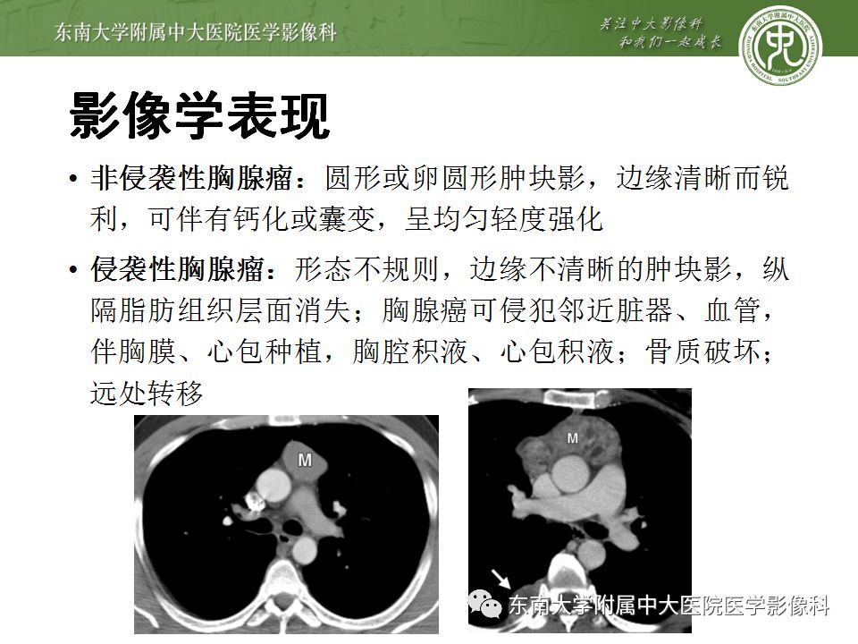 【病例】胸腺瘤1例CT影像诊断 【病例】胸腺瘤1例CT影像诊断