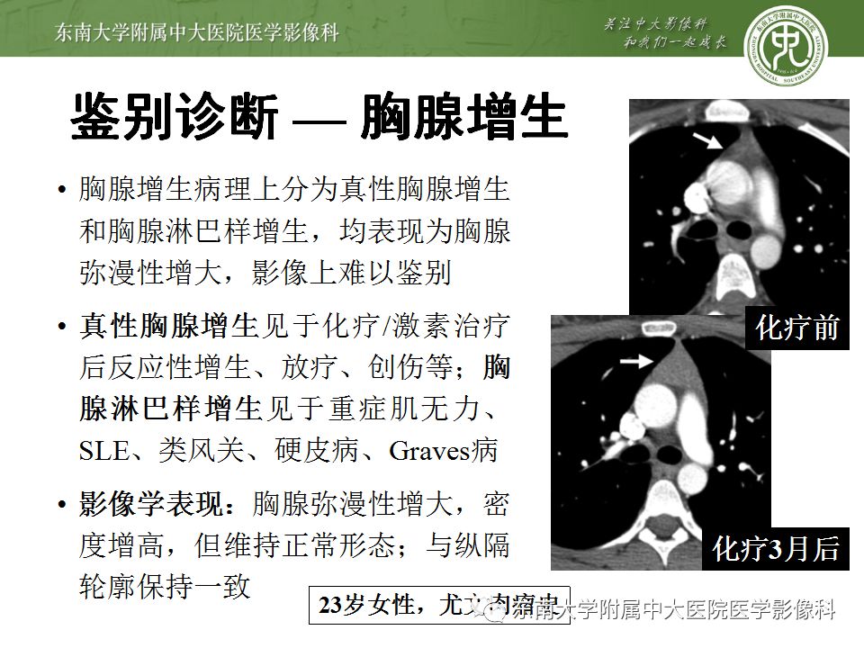 【病例】胸腺瘤1例CT影像诊断 【病例】胸腺瘤1例CT影像诊断