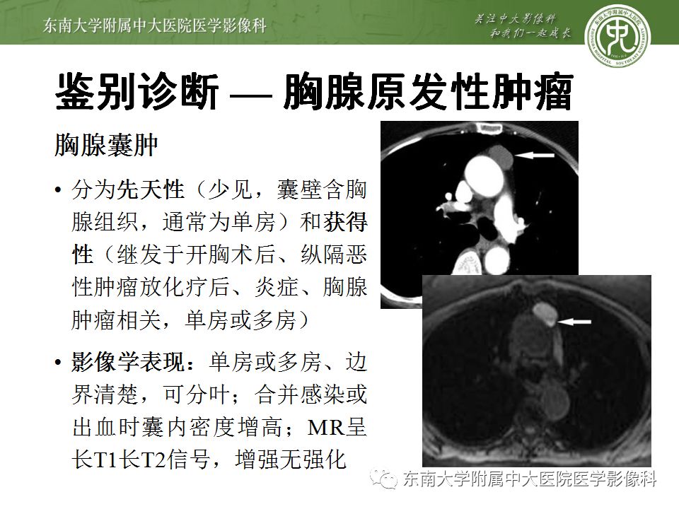 【病例】胸腺瘤1例CT影像诊断 【病例】胸腺瘤1例CT影像诊断