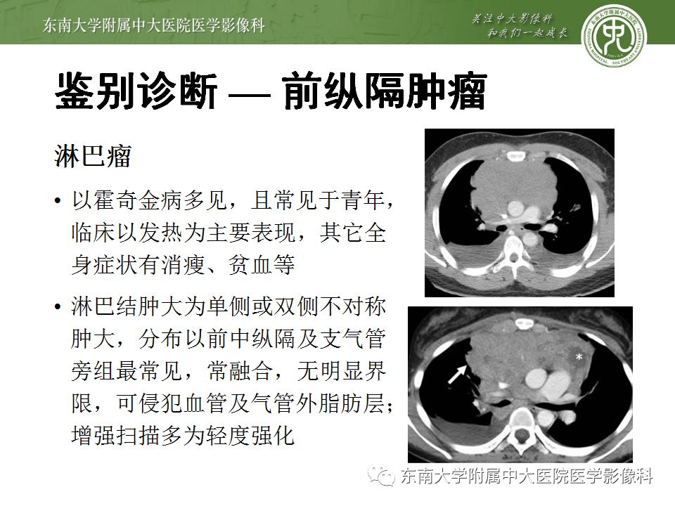 【病例】胸腺瘤1例CT影像诊断 【病例】胸腺瘤1例CT影像诊断