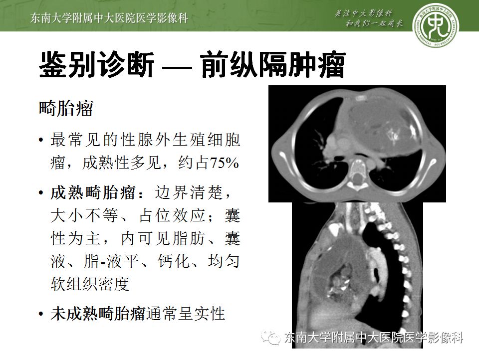 【病例】胸腺瘤1例CT影像诊断 【病例】胸腺瘤1例CT影像诊断