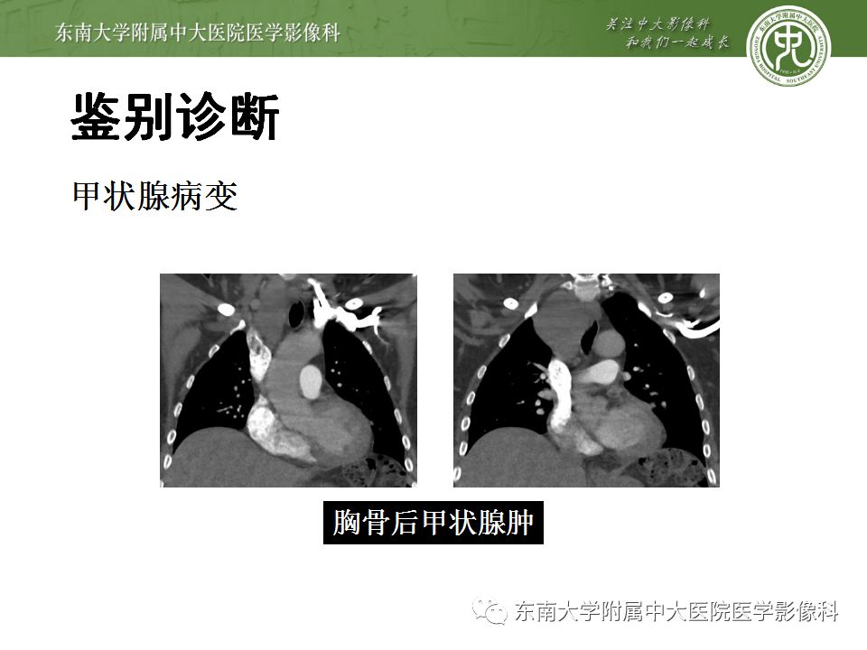 【病例】胸腺瘤1例CT影像诊断 【病例】胸腺瘤1例CT影像诊断