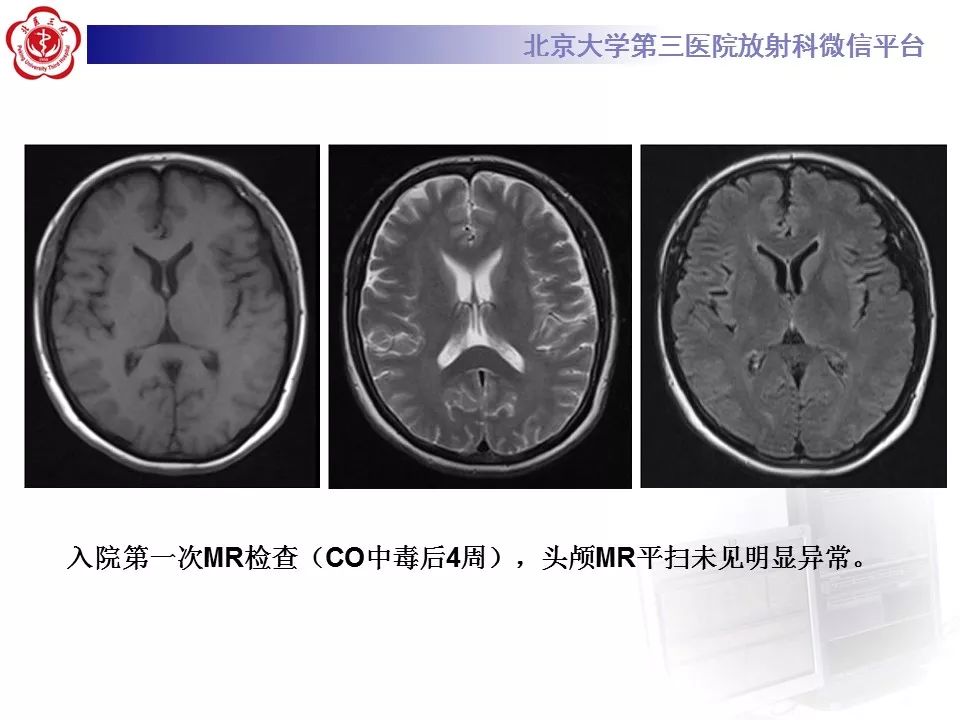 【病例】急性一氧化碳中毒迟发性脑病1例MR影像诊断