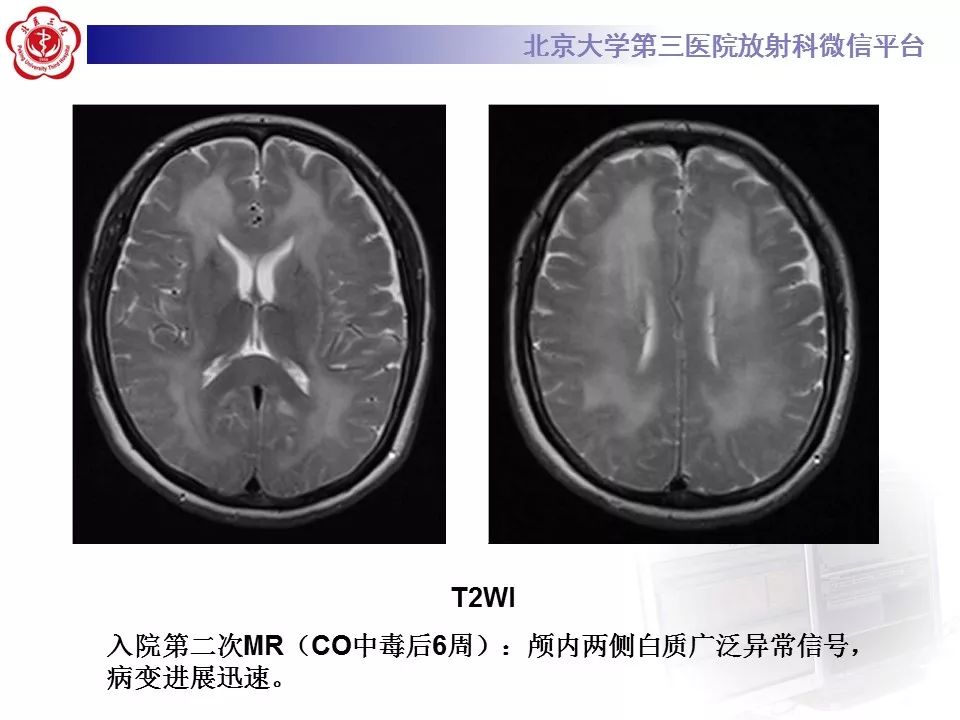【病例】急性一氧化碳中毒迟发性脑病1例MR影像诊断